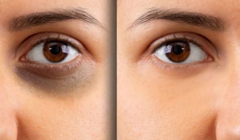 علاج الهالات السوداء تحت العين.. أسبابها وأنواعها